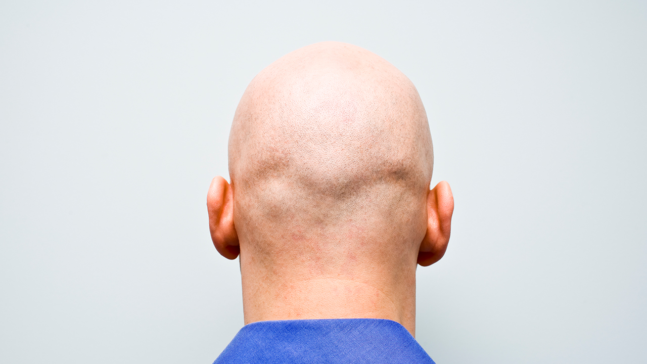 Baldness on sale cure 2020